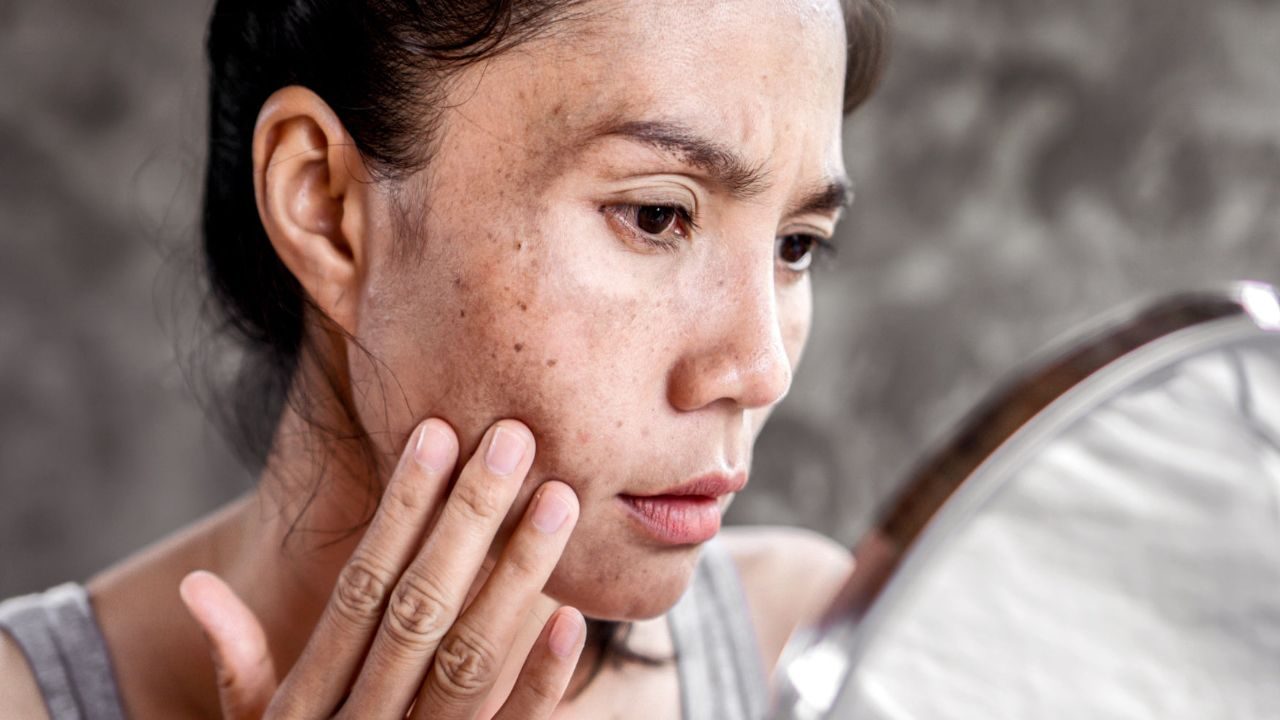 Causes of Hyperpigmentation